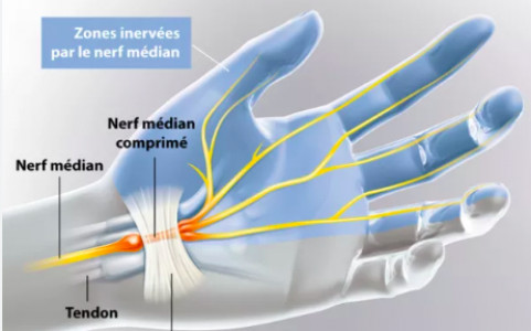 ostéopathie canal carpien Defaux 